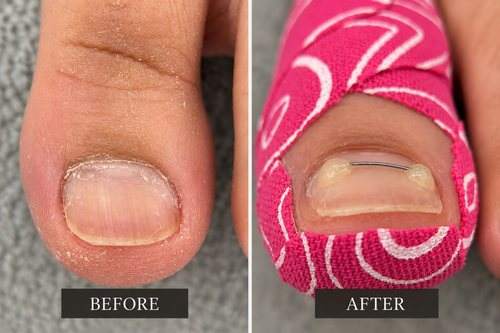 A curved toenail before the brace and with the brace fitted