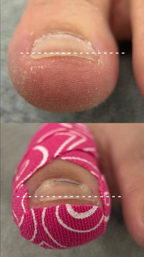 The same toenail before and after fitting, with the free edge marked