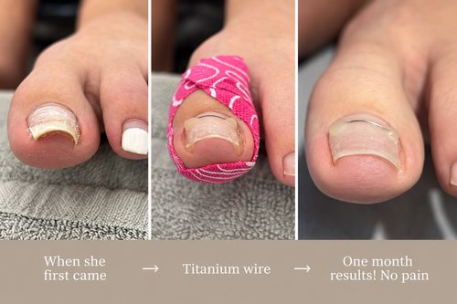 A toenail as it arrived, with a titanium wire fitted, and one month later