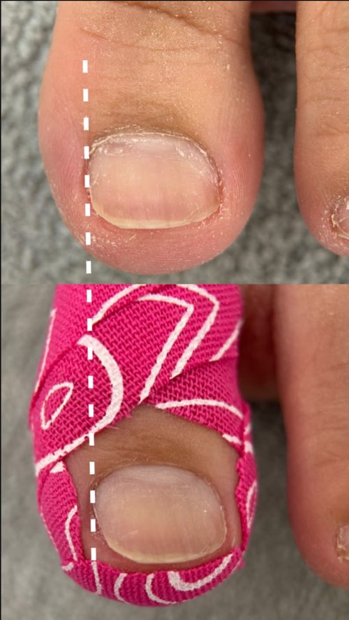 The same toenail before and after fitting, with the nail edge position marked