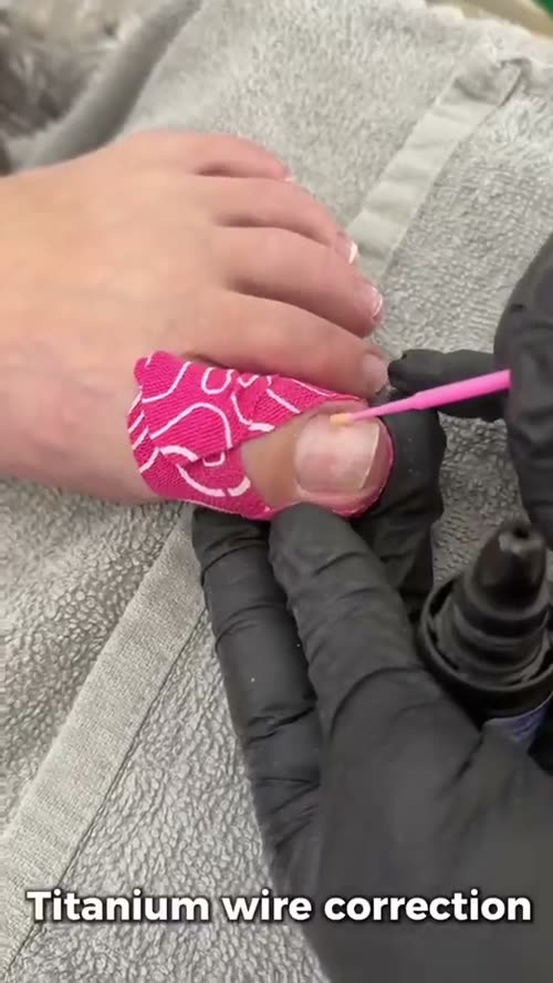 Fitting a titanium wire brace