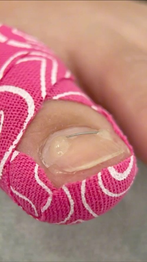 A titanium wire correction from start to finish