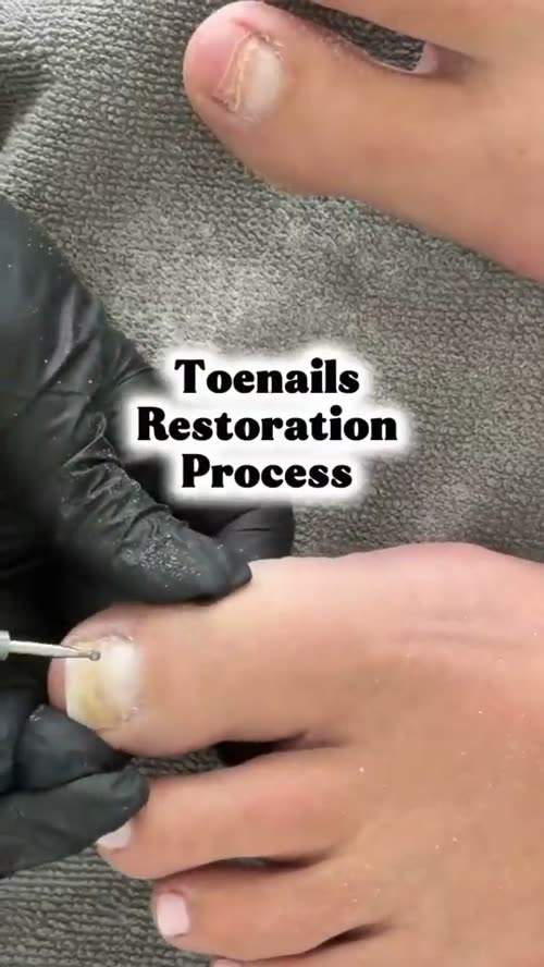 Toenail Reconstruction by Sky Spa