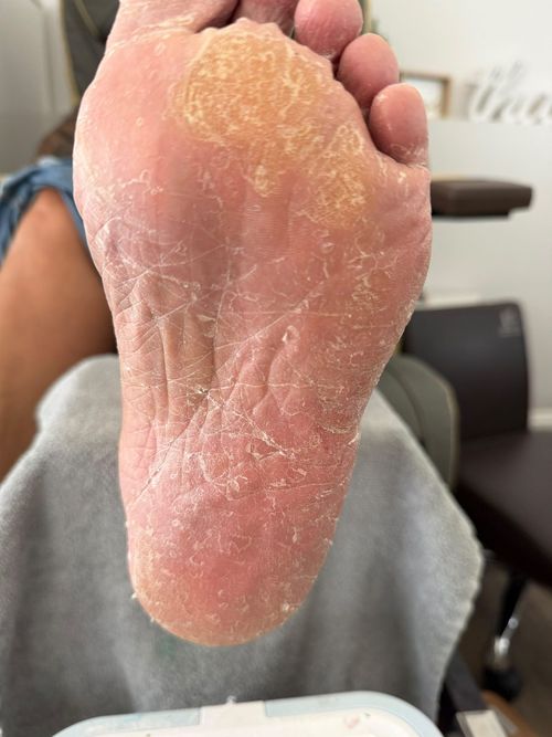 Heavy callus buildup at the start of an appointment