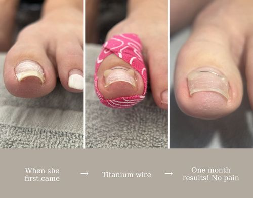 A damaged toenail, a titanium wire brace fitted, and the result one month later